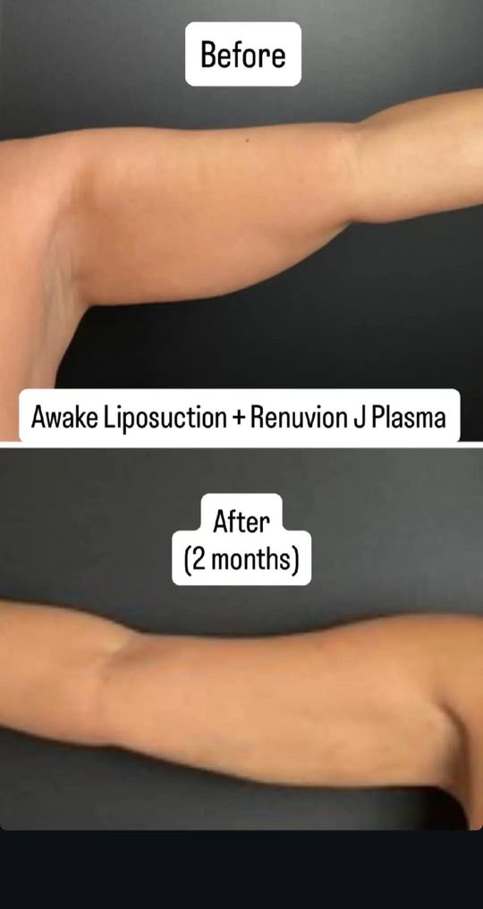Video by Dr. Jeffrey S. Yager: Ya no tienes que preocuparte por anestesia general, tambien despierta con anestesia local podemos…