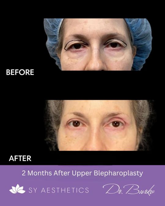 Video by Dr. Jeffrey S. Yager: blepharoplasty de parpados