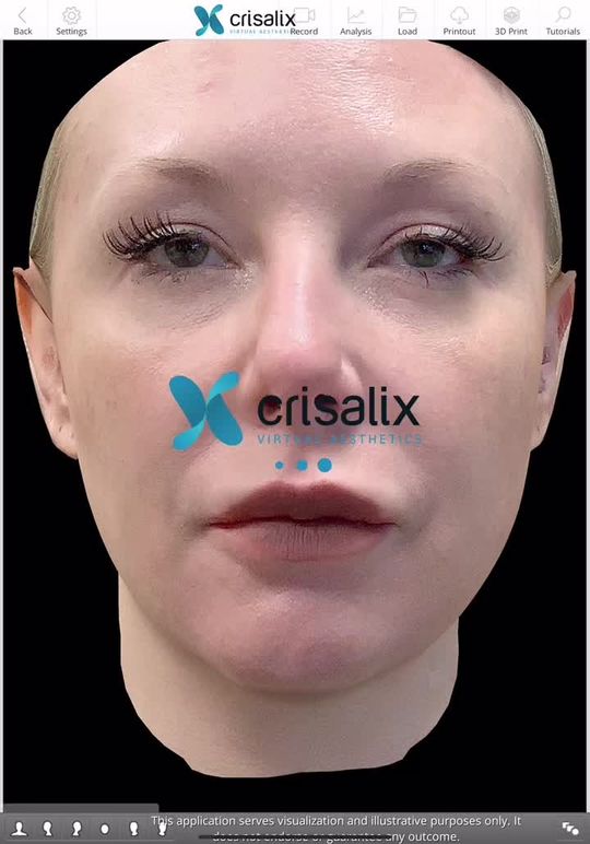 Video by Dr. Jennifer L. Walden: Have you ever wanted to see what your potential surgical results could be prior to surgery? Come…