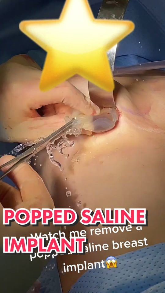 Video by Dr. Jimmy S. Firouz: Yes, it popped. 😱