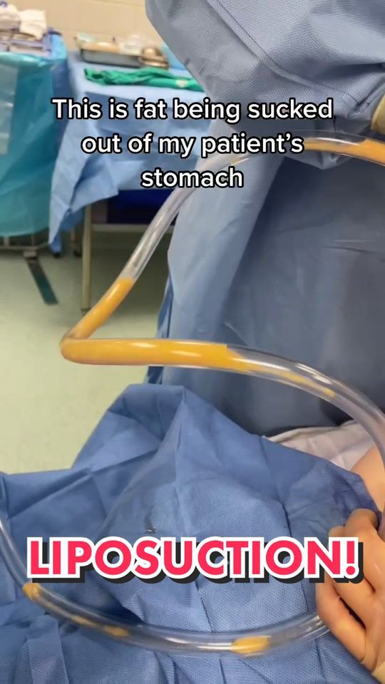 Video by Dr. Jimmy S. Firouz: Can you guess where I injected this fat after sucking it out?😏