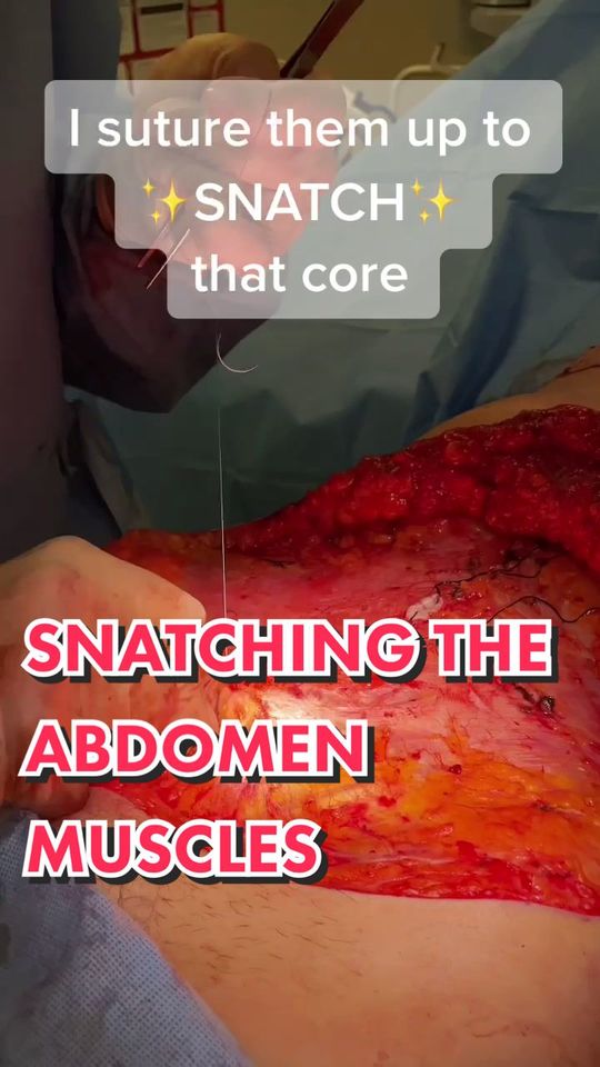 Video by Dr. Jimmy S. Firouz: Did you know this is how Tummy Tucks are done?😳👍🏻