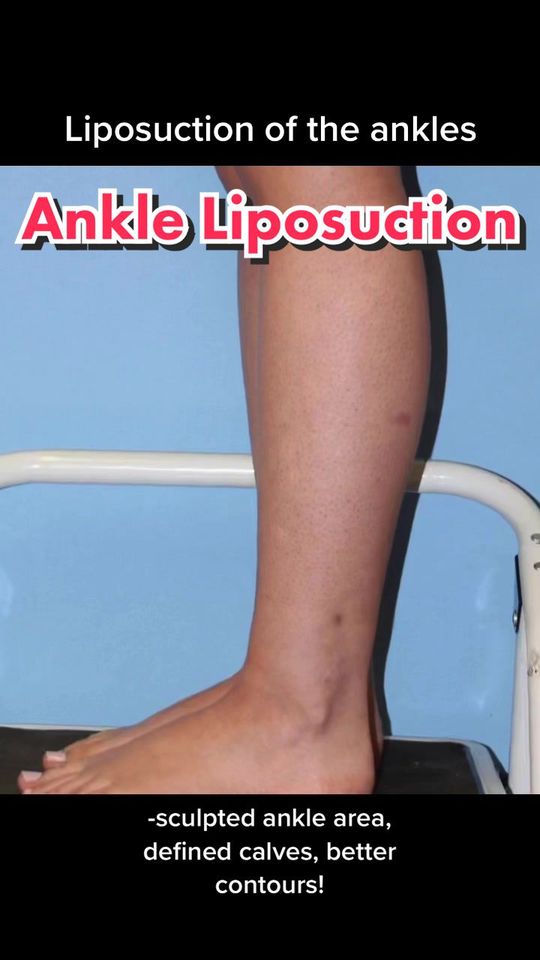 Video by Dr. Jimmy S. Firouz: I remove the extra fat that’s stored in the ankles to improve the contours of the area! Some call…