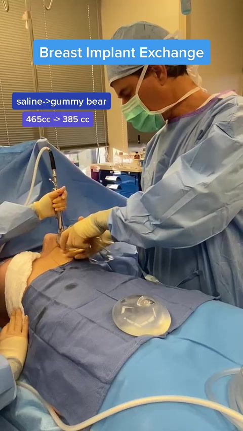 Video by Dr. John L. Burns Jr.: Breast implant exchange!Saline to gummy bear using a Keller funnel to avoid touching breast impla…