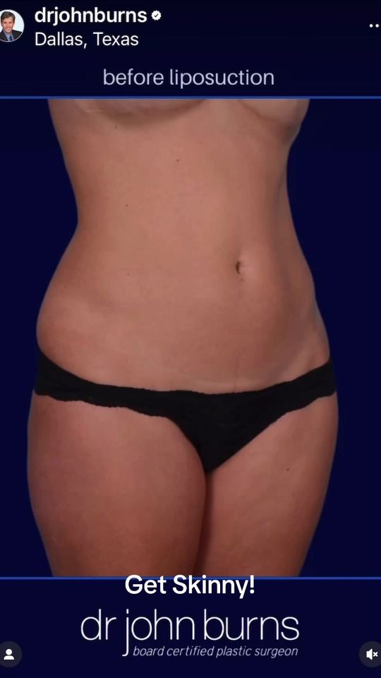 Video by Dr. John L. Burns Jr.: GET SKINNY. Vaser 4D Lipo 360. High Def with Abdominal etching. 1200cc fat removed.