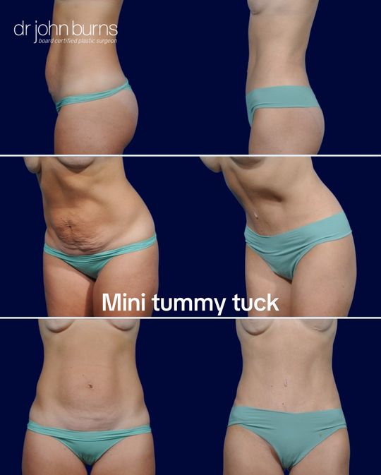 Video by Dr. John L. Burns Jr.: We love this procedure. Short scar bikini incision. Corset muscle plication. No scar belly button…