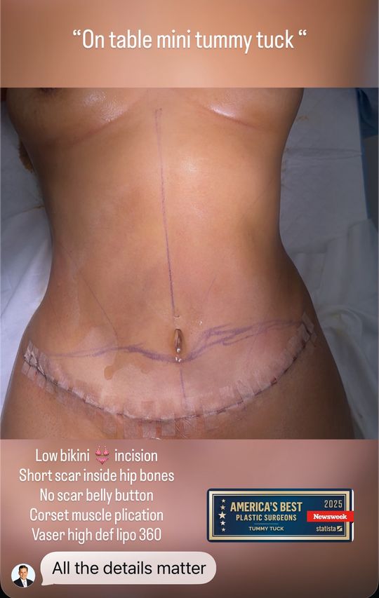 Video by Dr. John L. Burns Jr.: The details matter: low short scar bikini 👙 incision, no scar belly button (umbilical float), co…