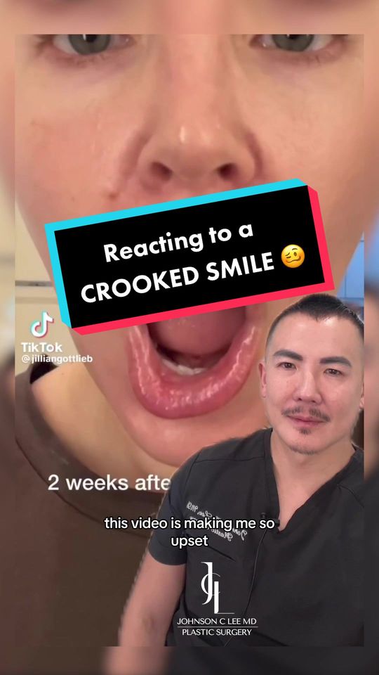 Video by Dr. Johnson C. Lee: Transforming Crooked Smiles: Restoring Symmetry with Expert Precision! 🌟 I wanted to address a r…