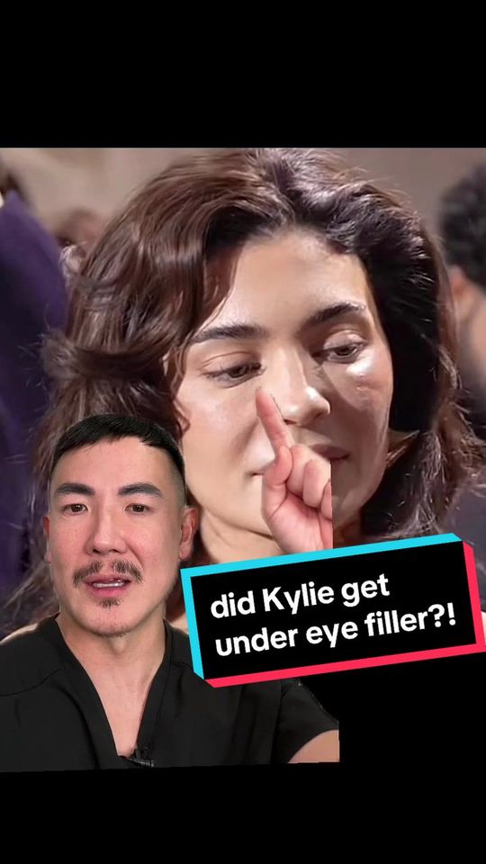 Video by Dr. Johnson C. Lee: This picture of Kylie Jenner from Paris fashion week really shows the work she may have had done,…