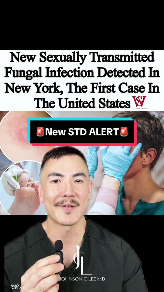 Video by Dr. Johnson C. Lee: Trichophyton mentagrophytes type VII (TMVII) is a rare and highly contagious fungal infection tha…