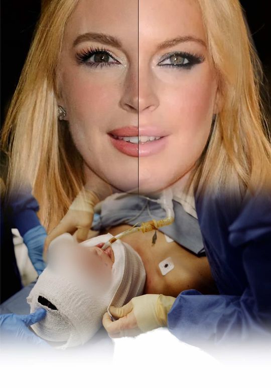 Video by Dr. Jonathan Zelken: Did Lindsay Lohan get plastic surgery? 🤔 Newport Beach, CA As a board-certified plastic surgeon,…