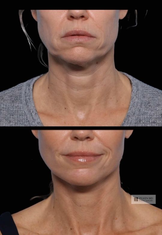 Video by Dr. Jonathan Zelken: I’m excited to share this transformation of a wonderful patient in her 40s who chose a deep plane…