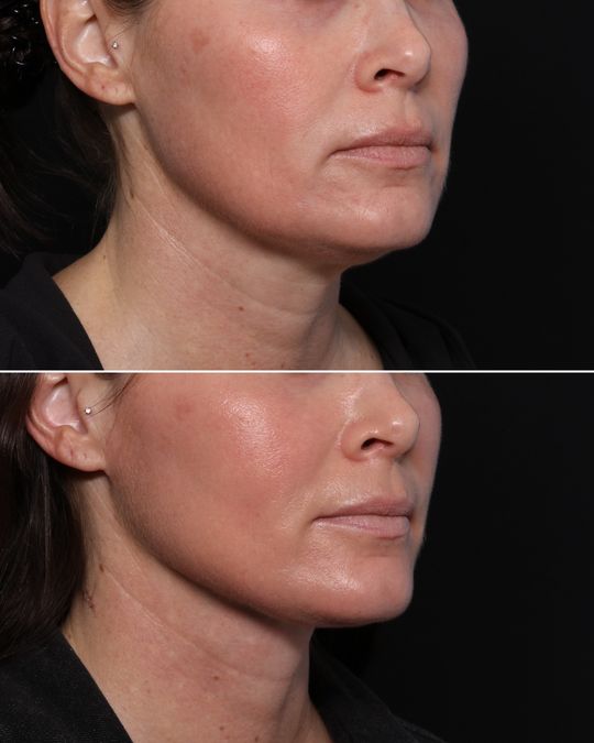 Video by Dr. Jonathan Zelken: Platysmaplasty, or a neck lift, is a procedure that tightens the neck muscles and removes excess…