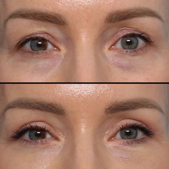 Video by Dr. Jonathan Zelken: Worried about downtime after eyelid surgery? This patient underwent an upper blepharoplasty along…