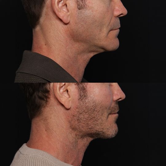 Video by Dr. Jonathan Zelken: Sometimes the right implant in the wrong place still leaves something missing. This patient came…