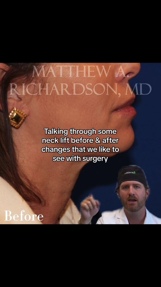 Video by Dr. Jordan Cain: Neck lift = game changer