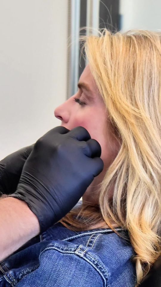 Video by Dr. Jordan Cain: Ready for a Valentine’s day glow up? 🌟 Cheek fillers restores lost volume, lifts sagging areas,…
