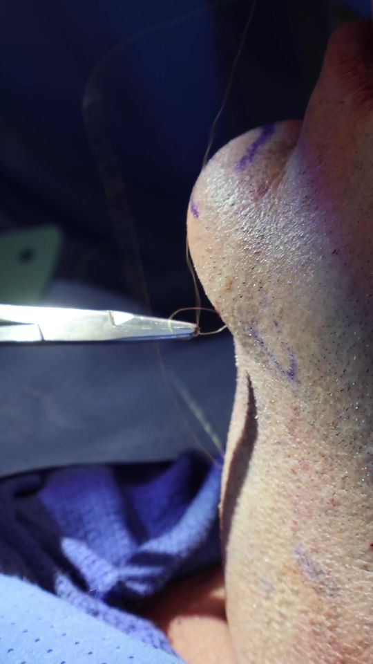 Video by Dr. Jordan Cain: ✨ A chin implant + submental lipo = the ultimate duo for facial balance! ✨ This combo removes exc…