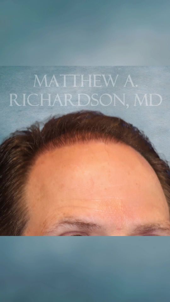 Video by Dr. Jordan Cain: Hair transplants don’t just restore hair—they restore youth and confidence! 🌟 These results are…