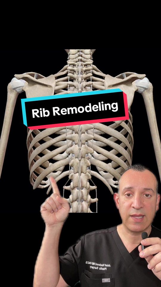 Video by Dr. Josef Hadeed: Rib remodeling surgery does not actually remove any bone — it only changes their orientation. The…