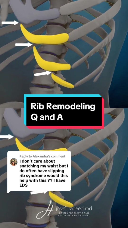 Video by Dr. Josef Hadeed: Replying to @Alexandra Someone on TikTok asked me if rib remodeling surgery will help with slippi…