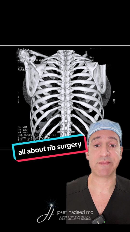 Video by Dr. Josef Hadeed: Let’s talk about rib remodeling surgery—a highly specialized procedure designed to cinch in and n…