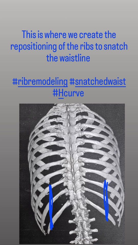 Video by Dr. Josef Hadeed: Rib remodeling is not the same as rib removal. With rib remodeling, the ribs are repositioned to…