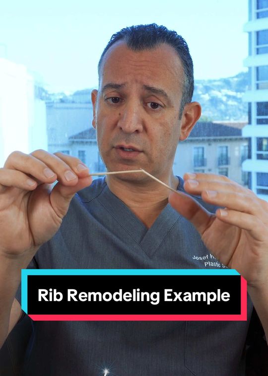 Video by Dr. Josef Hadeed: Rib remodeling is NOT rib removal! 🦴✨ This advanced technique repositions the ribs by creating a…