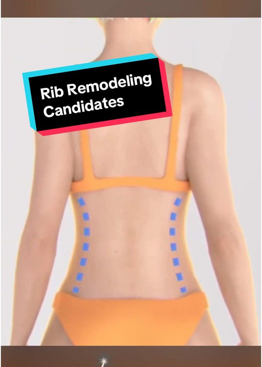 Video by Dr. Josef Hadeed: ✨ Looking for that snatched waistline? Rib remodeling could be the key, especially if you've been…
