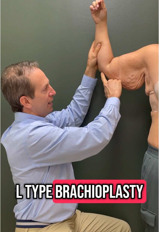 Video by Dr. Joseph Parks: Key points to address with an arm lift surgery with Dr. Fallucco! 1. Skin excess of arm (just the…