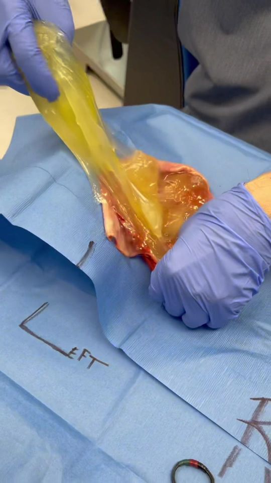 Video by Dr. Joshua Lampert: Look at these implants from 2007. See what happened to one of them 👀