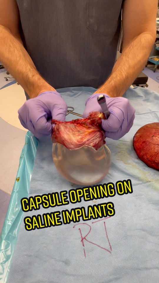 Video by Dr. Joshua Lampert: Take a look at these thin crunchy capsules on these saline implants!