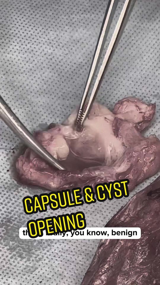 Video by Dr. Joshua Lampert: This young patient had complaints of breast pain that prevented her from sleeping properly. She f…