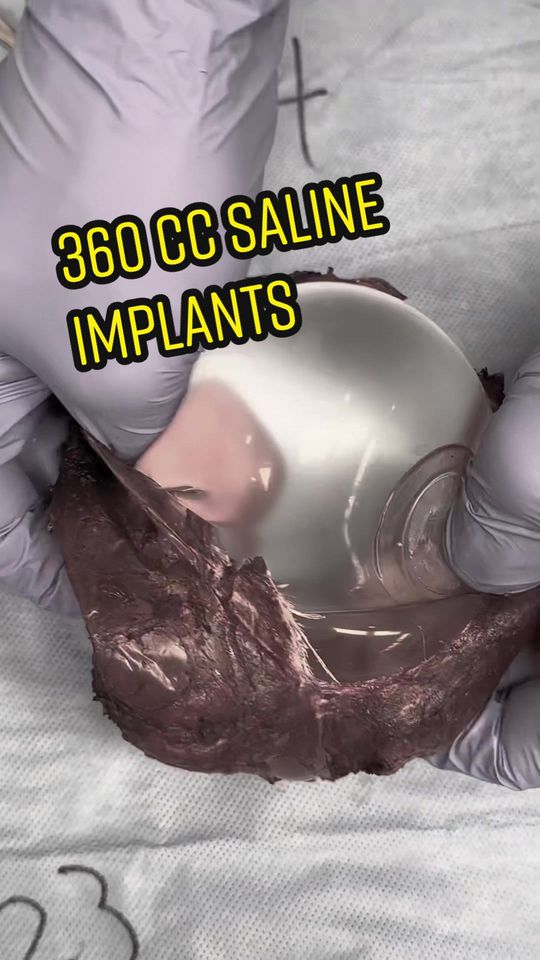 Video by Dr. Joshua Lampert: @lampertmd We removed some 360cc saline implants that were about 9 years old. She was having pain…
