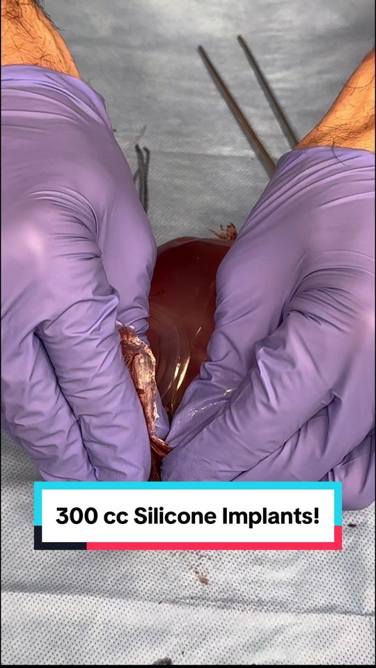 Video by Dr. Joshua Lampert: @Joshua Lampert, MD This 38 year old female patient presented to me with a primary complaint of b…
