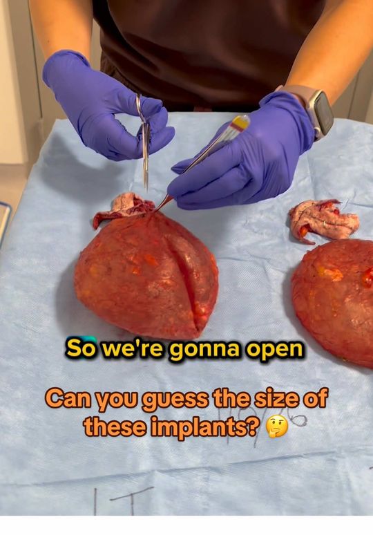 Video by Dr. Joshua Lampert: Kicking off the year with our first capsule opening! This patient experienced BII symptoms I perf…