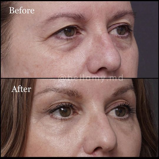 Video by Dr. Justin L. Bellamy: All under LOCAL anethesia! This patient is 3 months post opperation & loving her results!😃