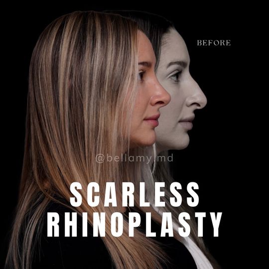 Video by Dr. Justin L. Bellamy: This beautiful patient is now 2 months post closed preservation SCARLESS rhinoplasty! No visible…