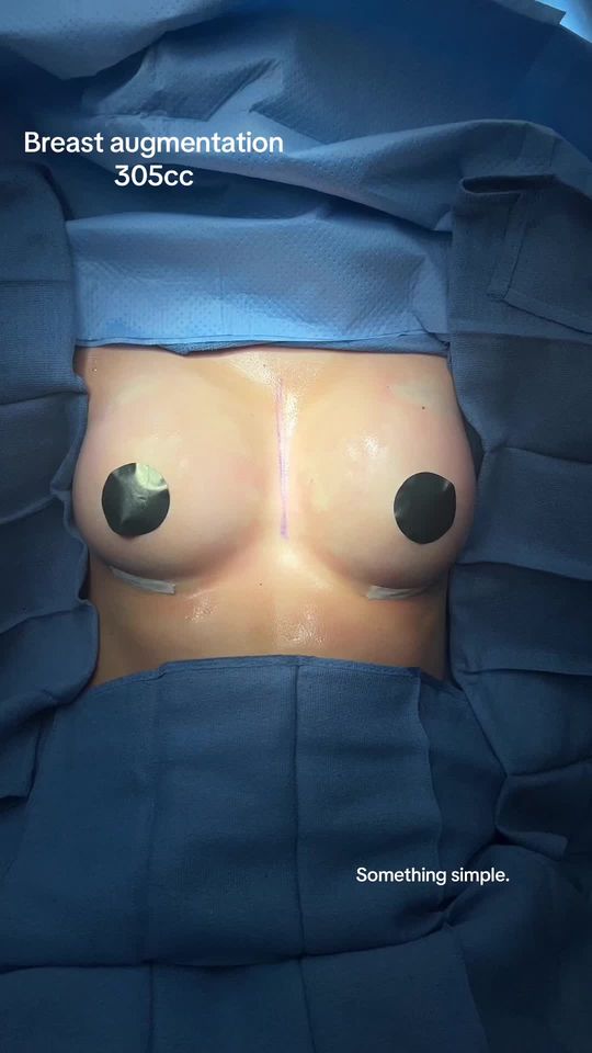 Video by Dr. Justin L. Bellamy: Silicone breast implants. A simple but impactful change 🙏🏽 305cc moderate plus profile Under th…