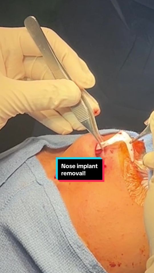 Video by Dr. Justin L. Bellamy: 🩸🩸Removal of infected silicone nasal implant that had been placed in China for bridge augmentat…