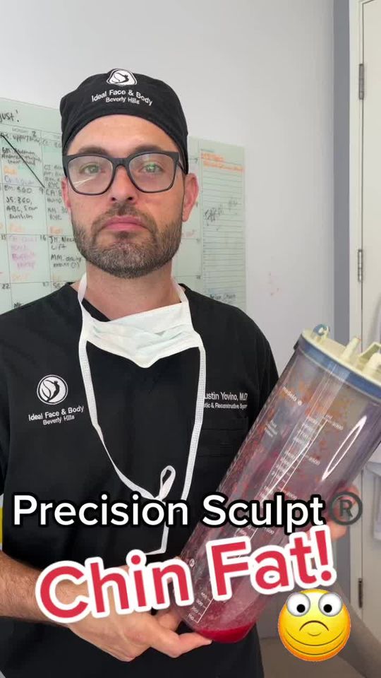 Video by Dr. Justin Yovino: PRECISION SCULPT®️ CHIN, NECK, & JAWLINE. This procedure is performed comfortably awake in the of…