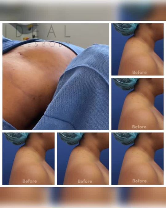 Video by Dr. Justin Yovino: PRECISION SCULPT®️ Buffalo Hump Removal. This is a very rewarding procedure especially for female…