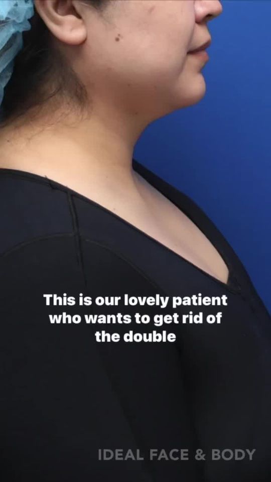 Video by Dr. Justin Yovino: Double chin PRECISION SCULPT®️ This is performed comfortably in the office with excellent local a…