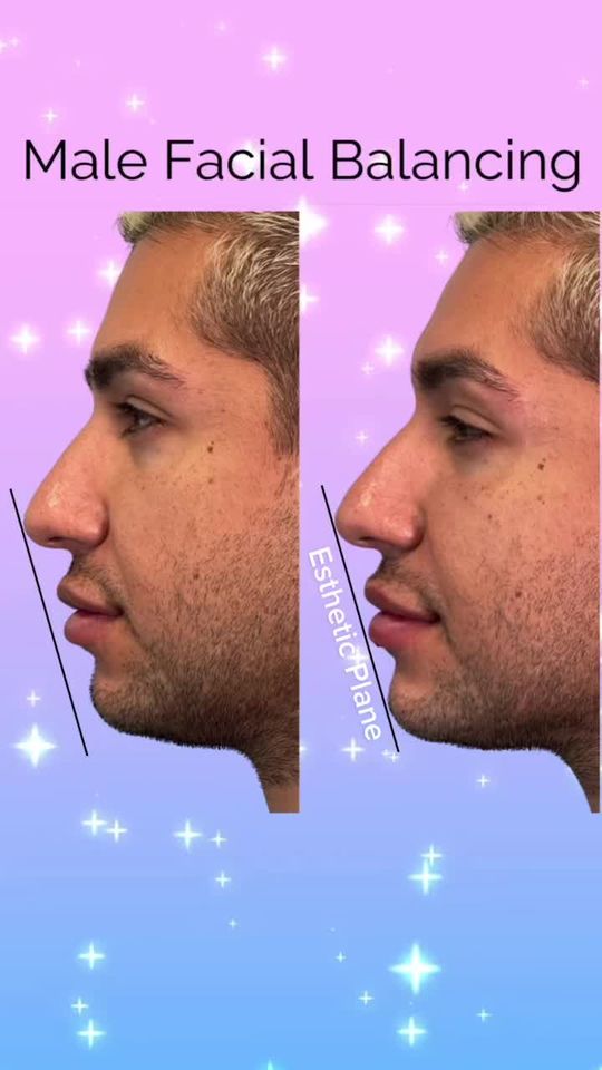 Video by Dr. Justin Yovino: The Esthetic Plane or “E” Plane was named by Dr. Robert Ricketts. This line, drawn from the top o…