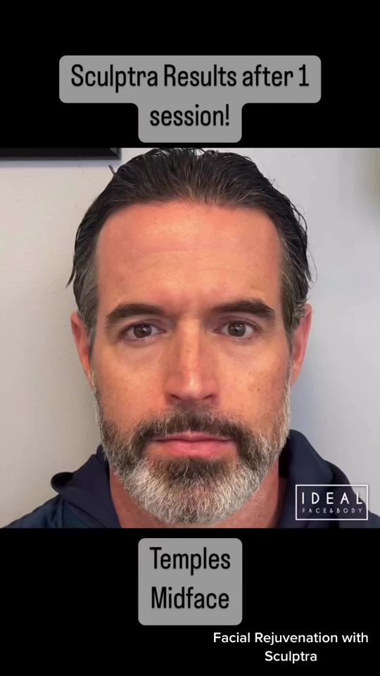 Video by Dr. Justin Yovino: Sculptra is not a traditional filler. It is a powdered implant that is injected to stimulate your…