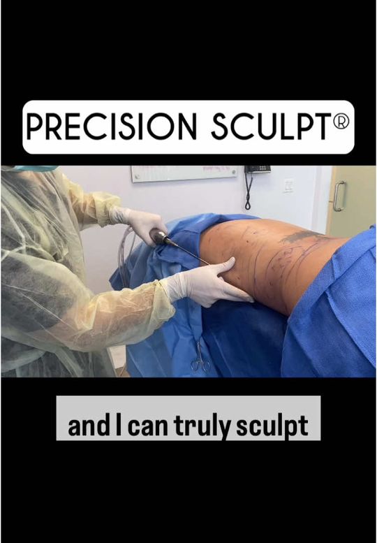 Video by Dr. Justin Yovino: This is how we sculpt the back without being blocked by the bed. This is a good tip for surgeons…