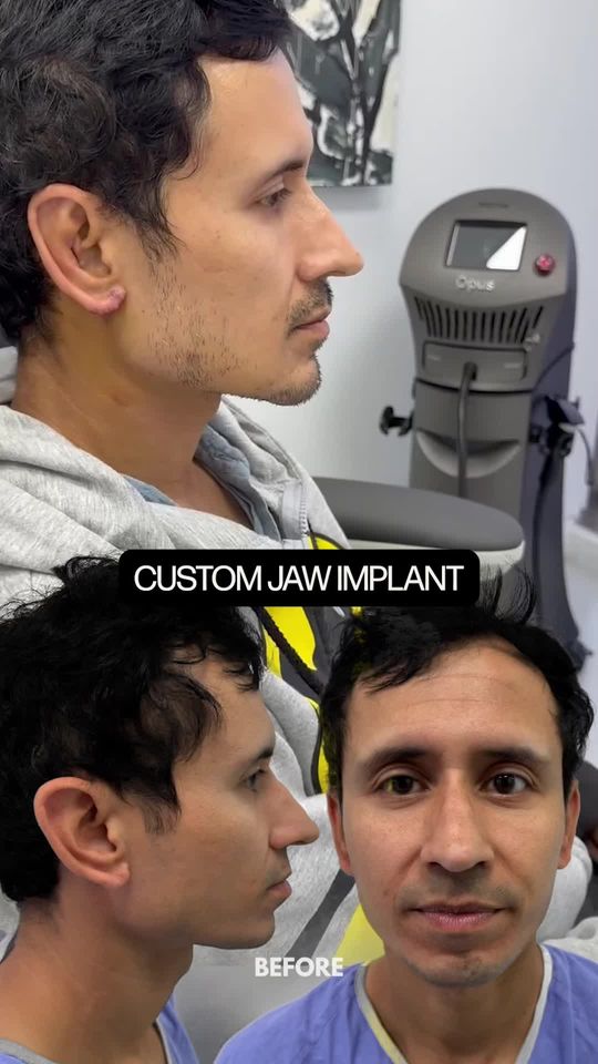 Video by Dr. Karan Dhir: Only 6 days post-op and look at that jawline! 💥💪🏼 This patient is healing beautifully after re…