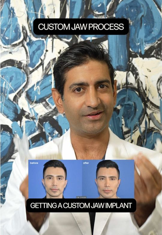 Video by Dr. Karan Dhir: If you’re considering a custom jaw implant, allow me to walk you through the unique process!