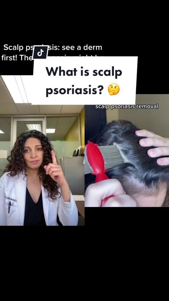 Video by Dr. Kaveri Karhade: Scalp psoriasis can be mild and almost unnoticeable. But it can also be severe, last a long time,…