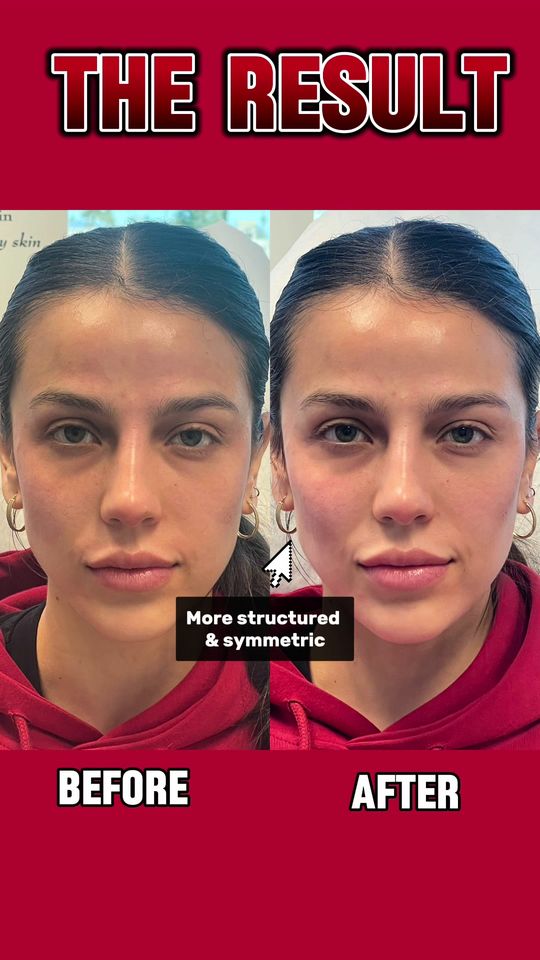 Video by Dr. Kay Durairaj: If you’re looking for a little lift, give cheek filler a consideration!